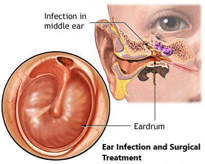 Ear Infections and Surgical Treatment in Bilaspur Chhattisgarh