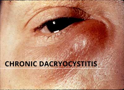 Echronic Dacryocystitis Treatment in Bilaspur Chhattisgarh