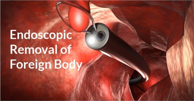 foreign-body-removal-by-endoscopy Surgery in Bilaspur Chhattisgarh